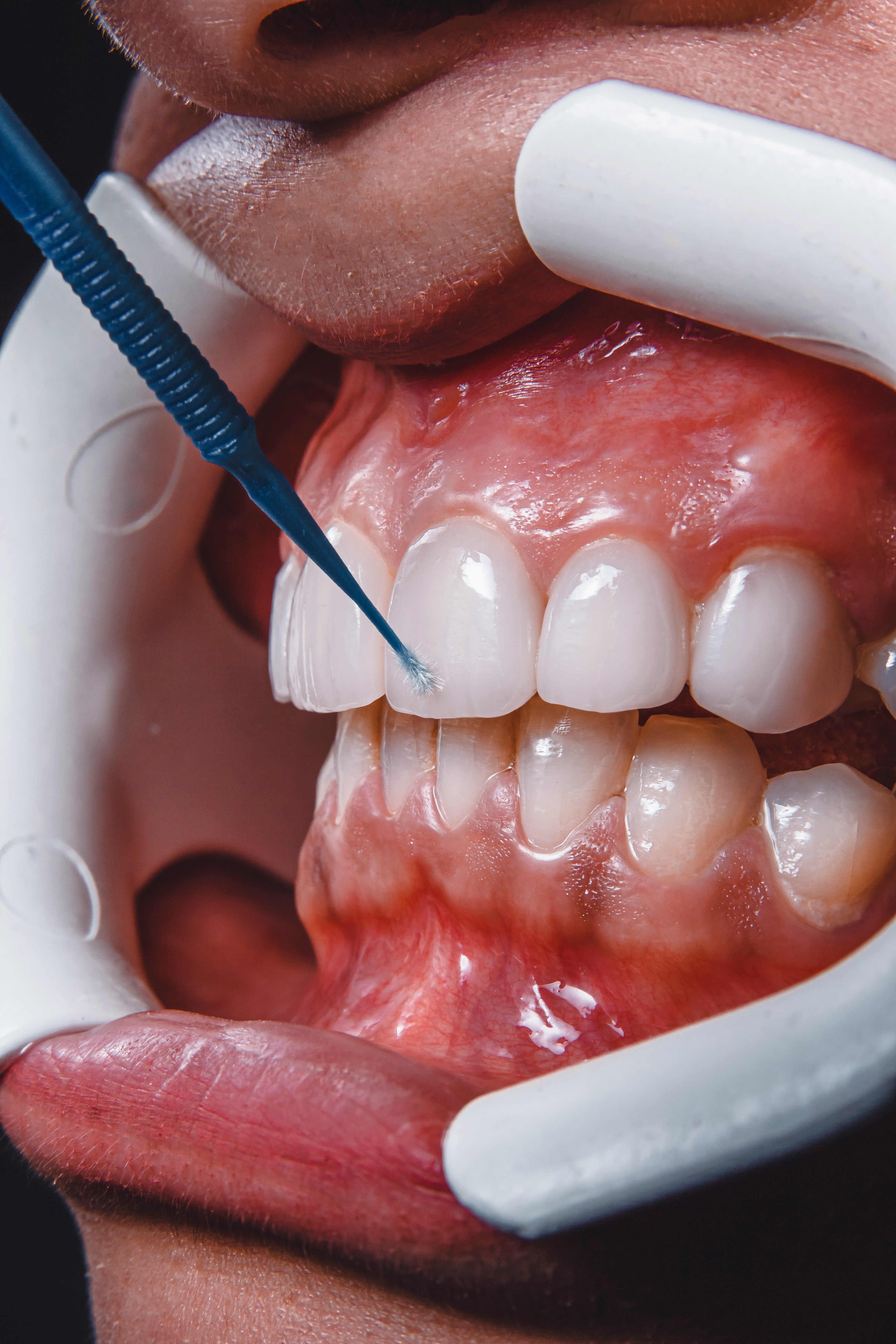 Tooth Color Restoration