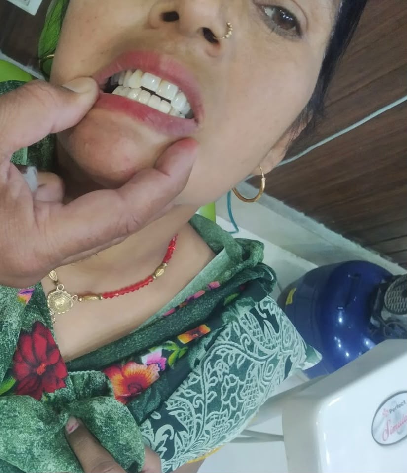After Dental Crowns