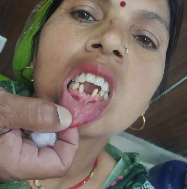 Before Dental Crowns