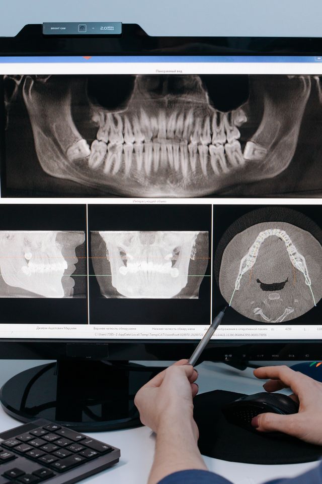 Dental X-Ray