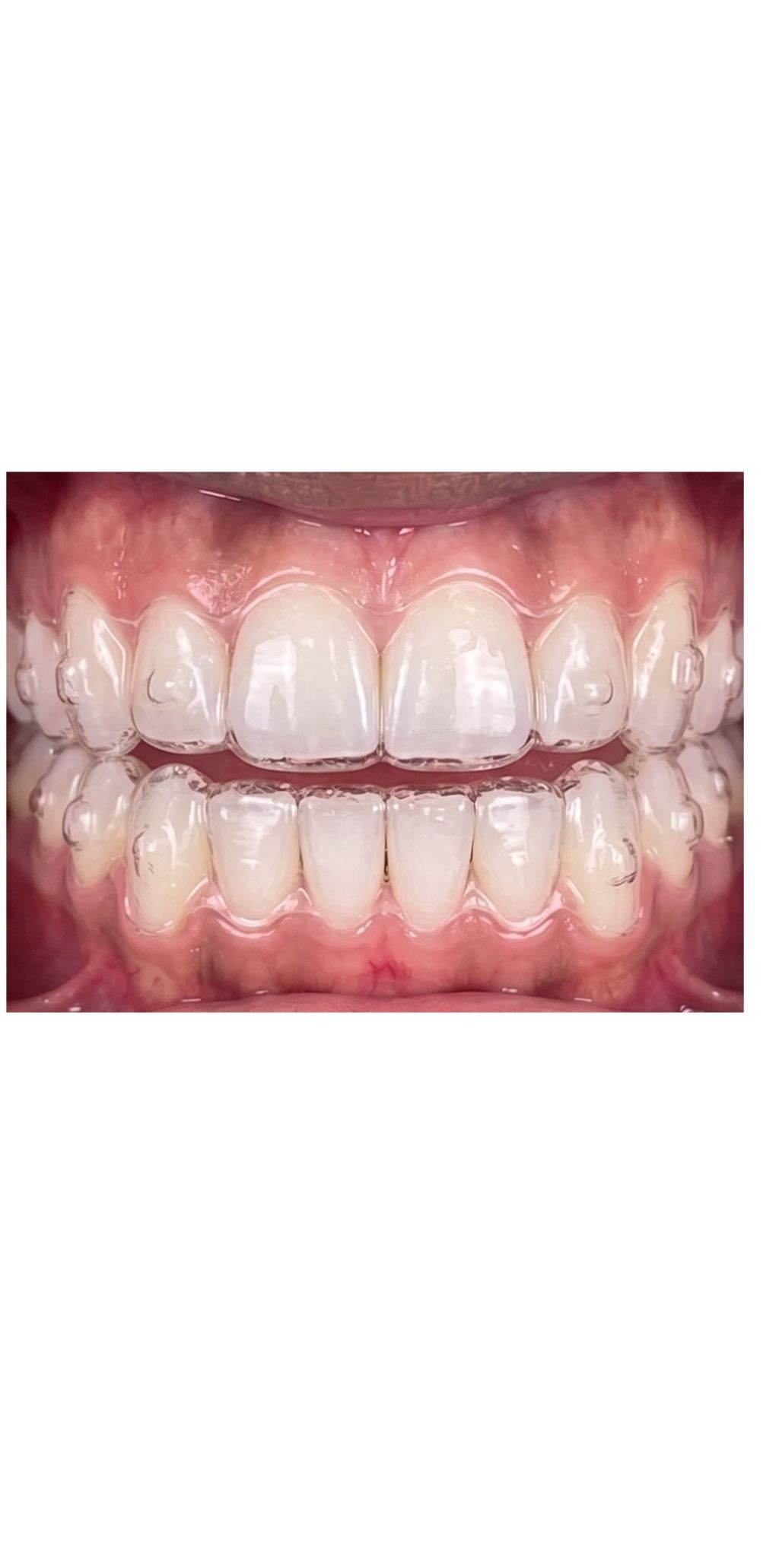 Partial & Complete Dentures
