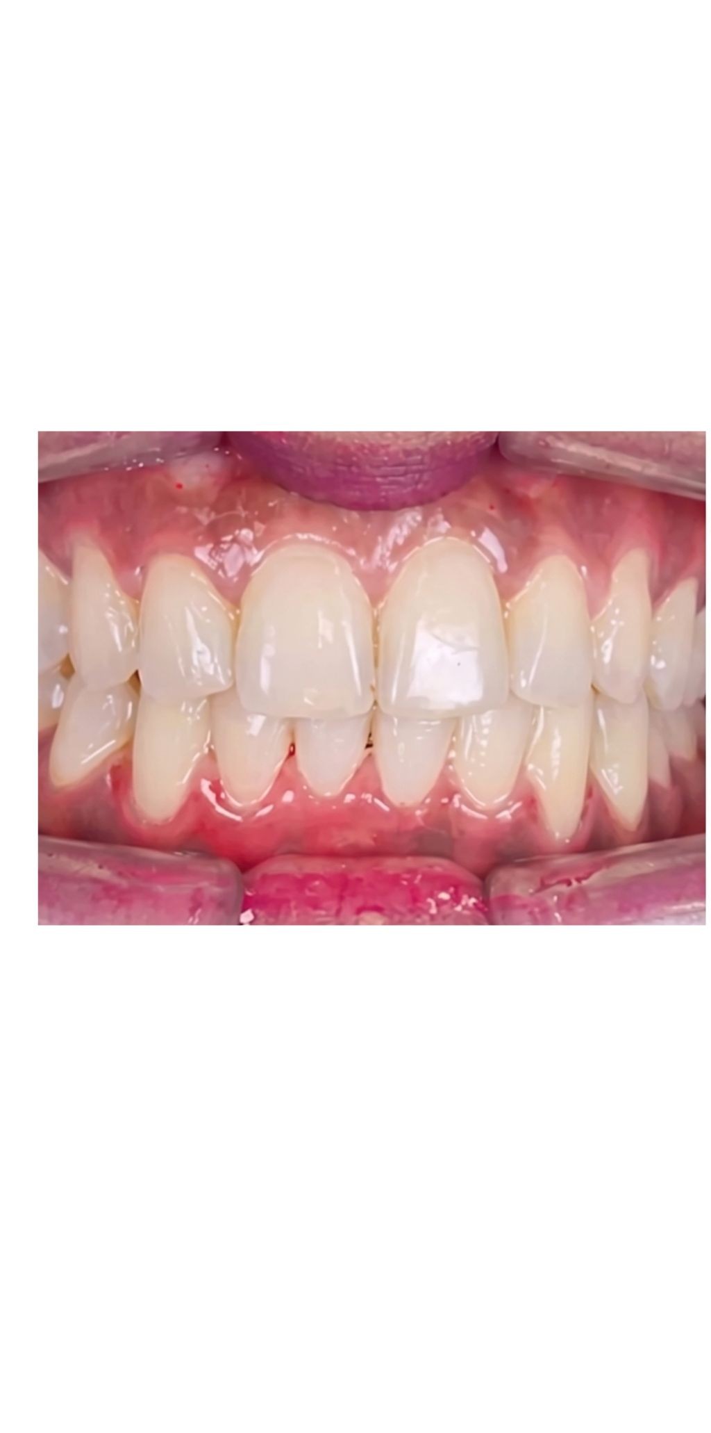 Before Invisible Aligners