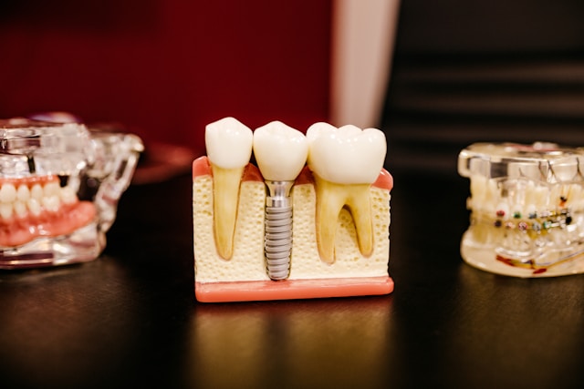 Root Canal Treatment