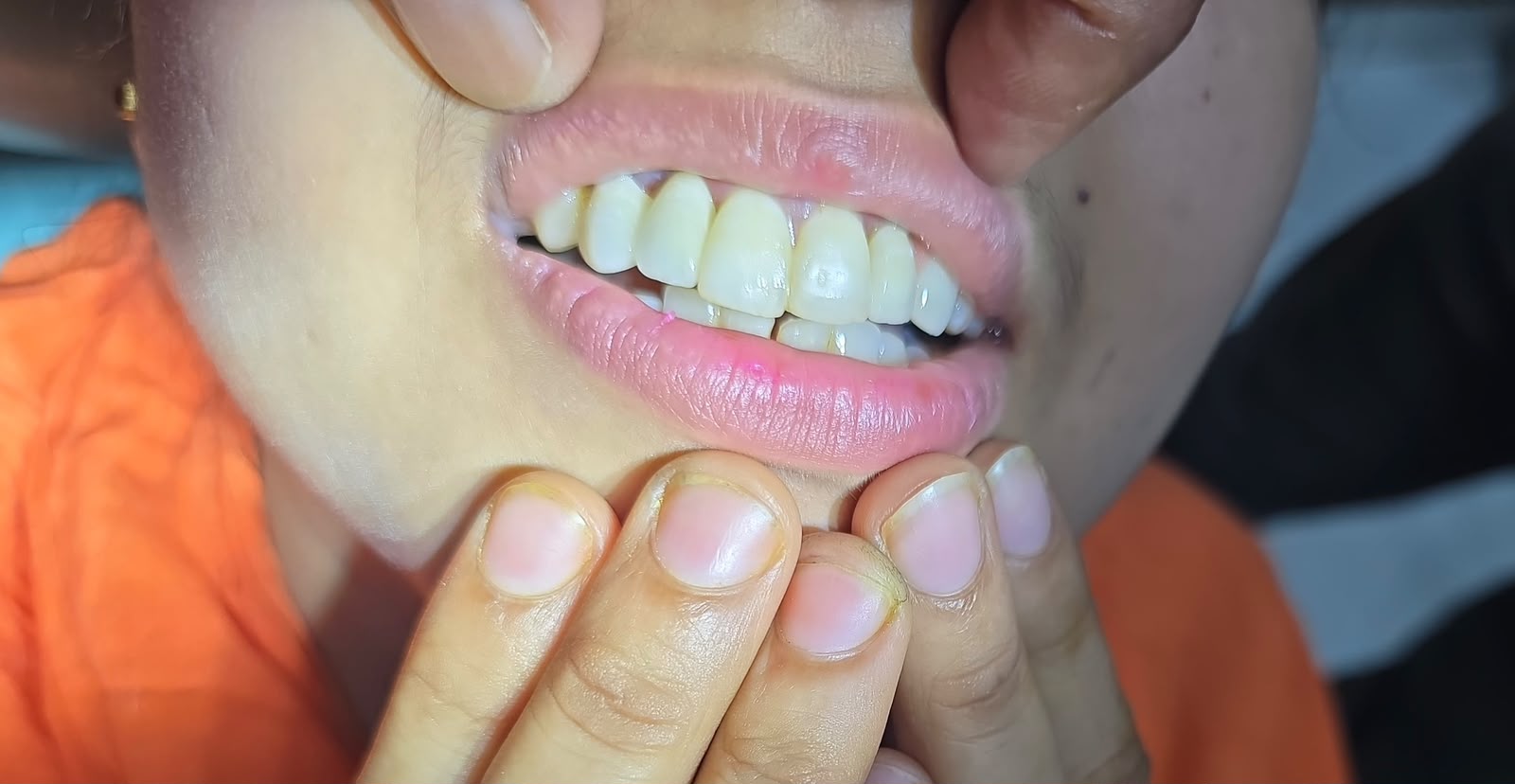 Before Teeth Whitening