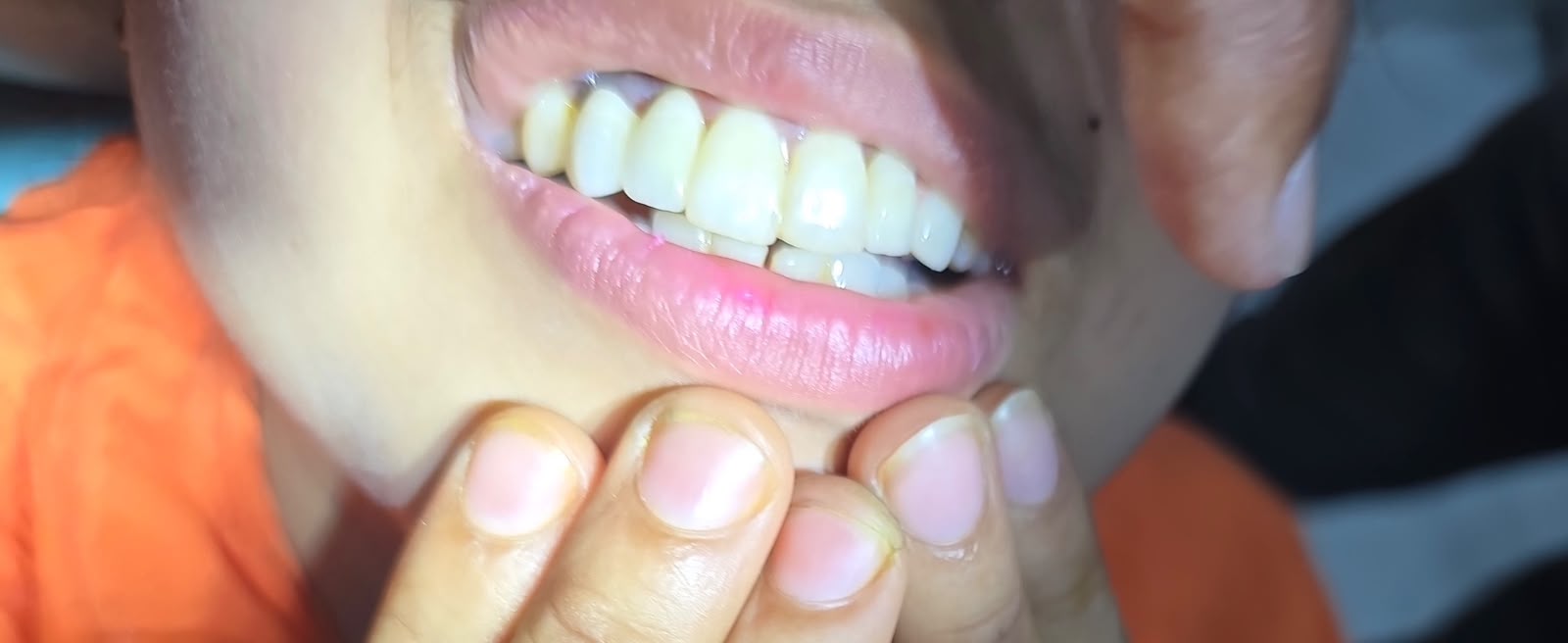 After Teeth Whitening
